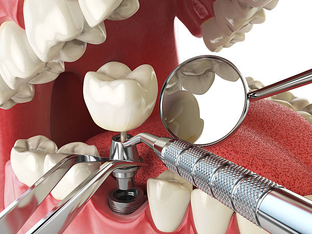 Best Emergency Dentist for Knocked-Out Tooth in Lindsborg, KS